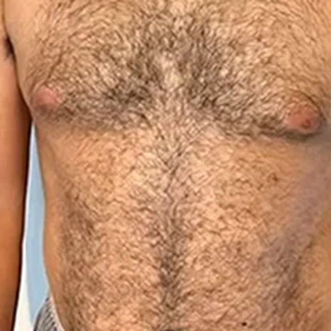 Avant épilation — torse homme (format 1:1)